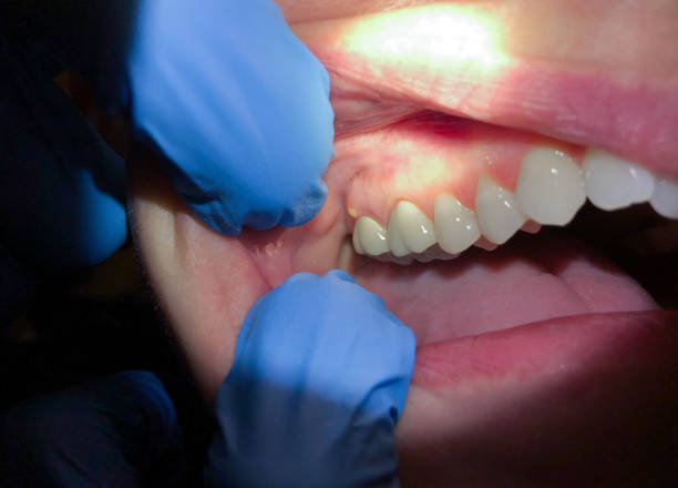 Best After-Hours Emergency Dentist in Saint John Fisher College, NY